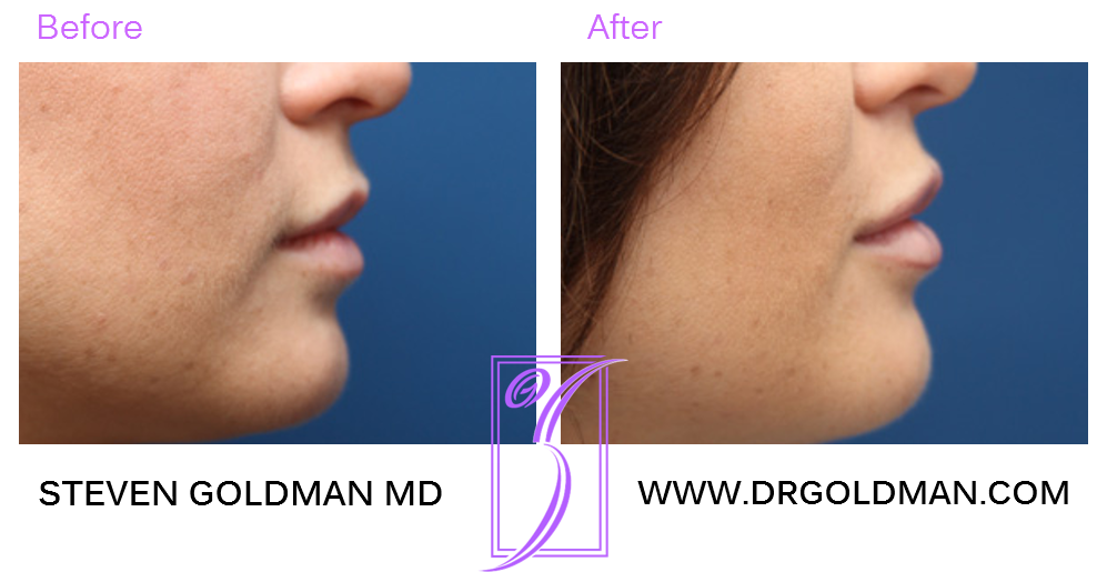 Lip Enhancement