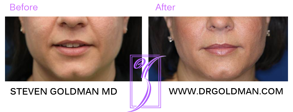 Dermal Filler