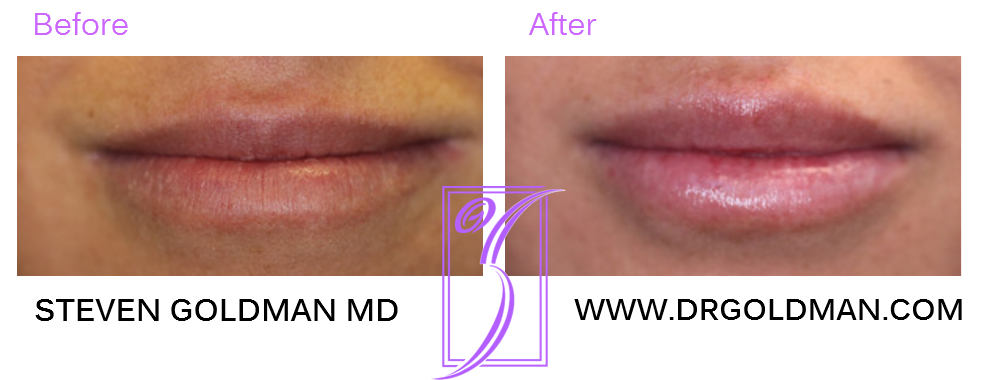 Lip Enhancement