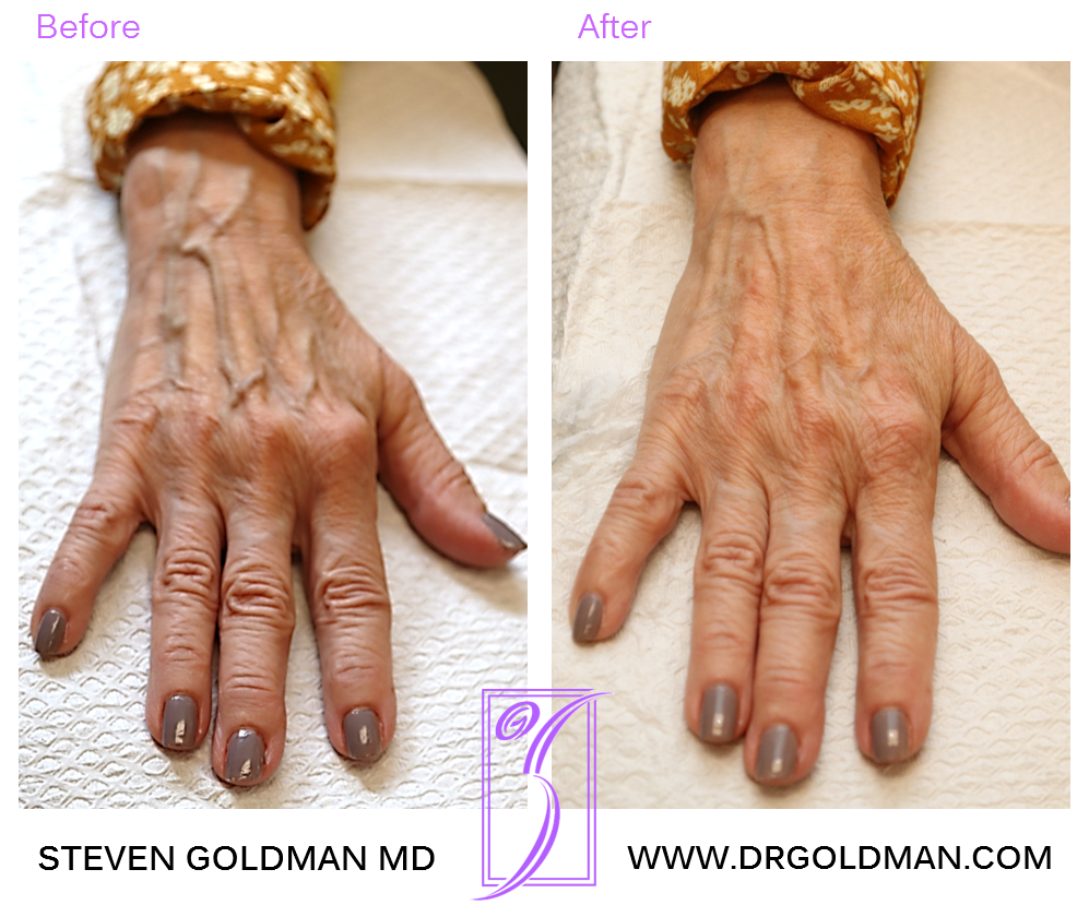 Filler for hands