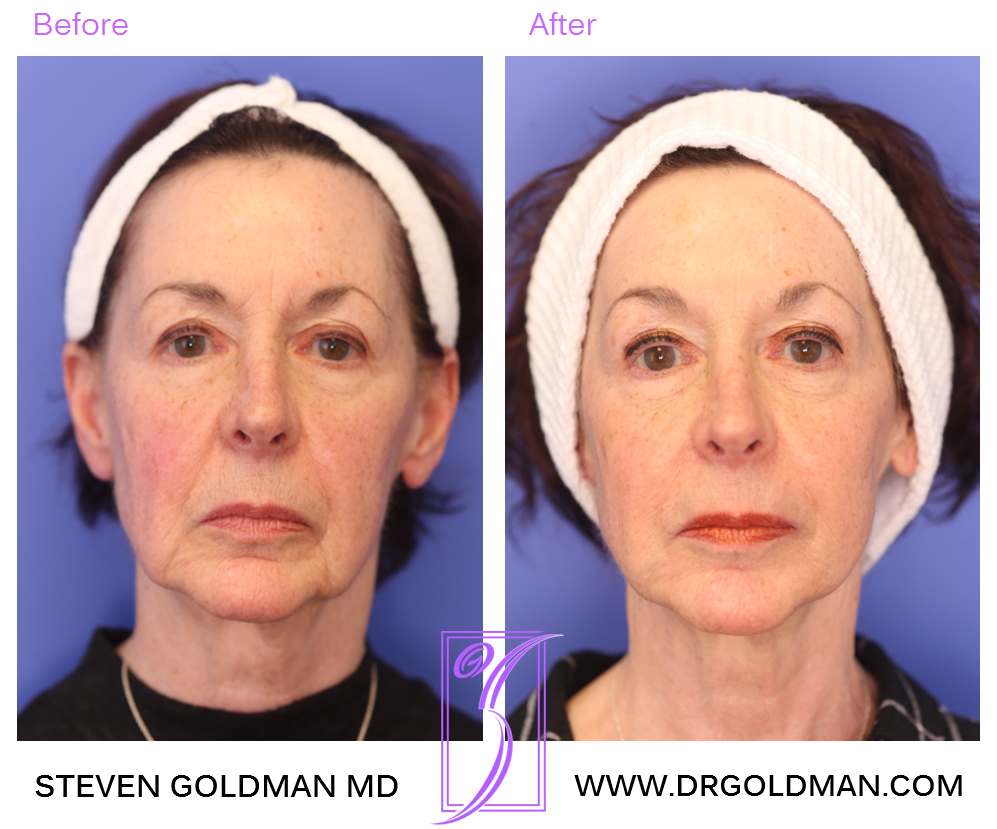 Dermal Fillers