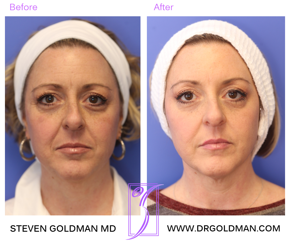 Dermal Filler