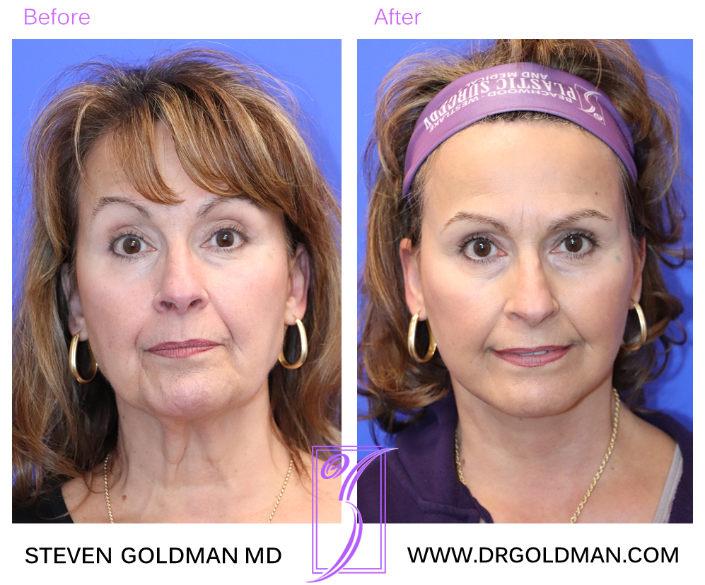 Facelift