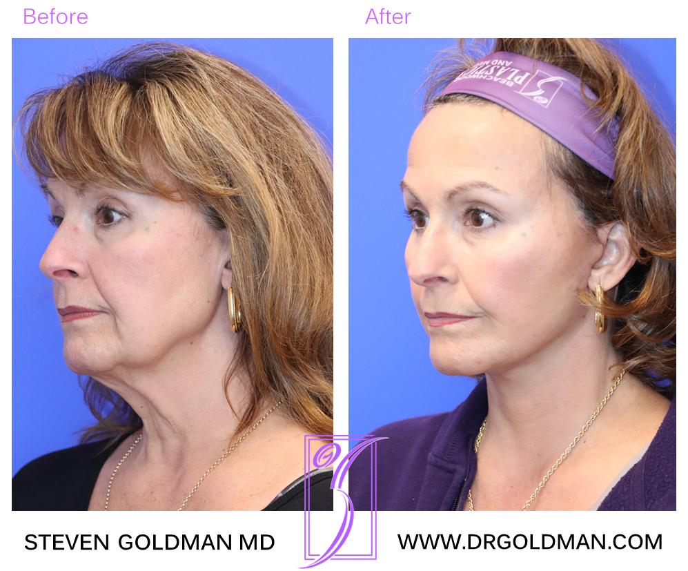 Facelift