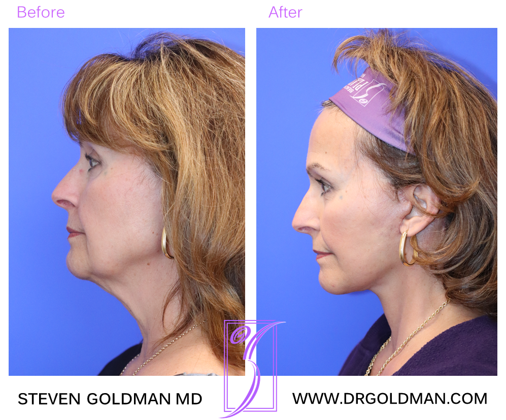 Facelift