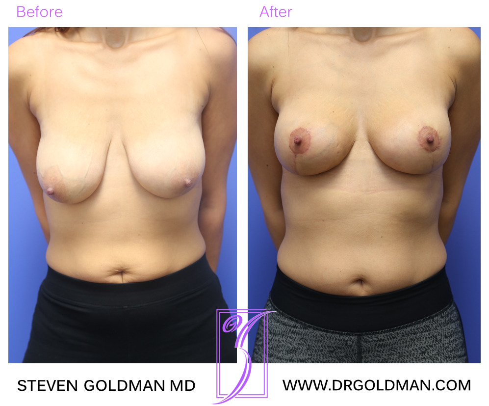 Breast Lift