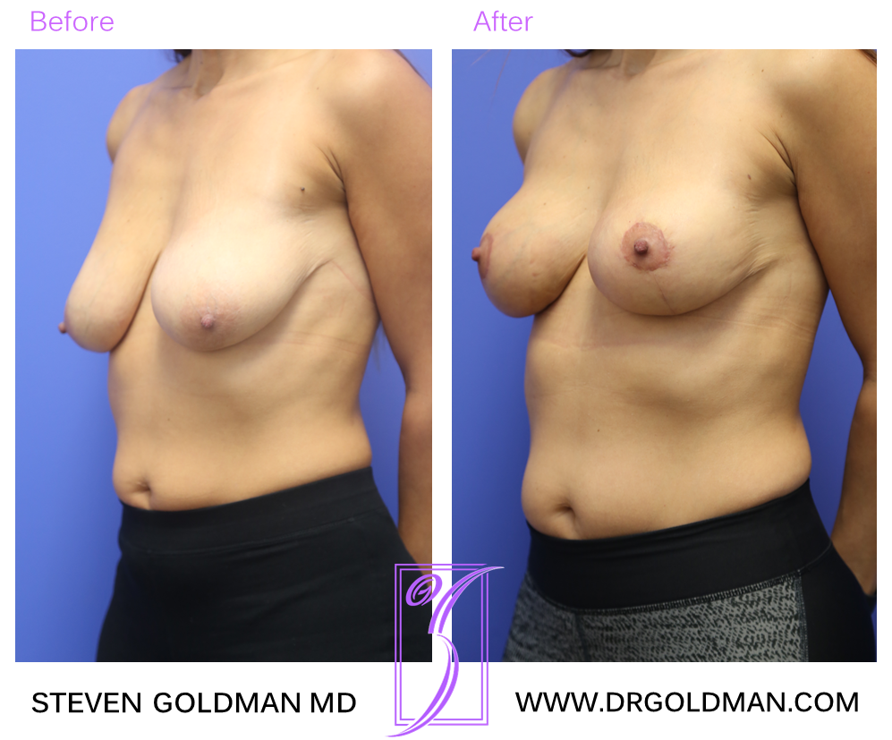 Breast Lift