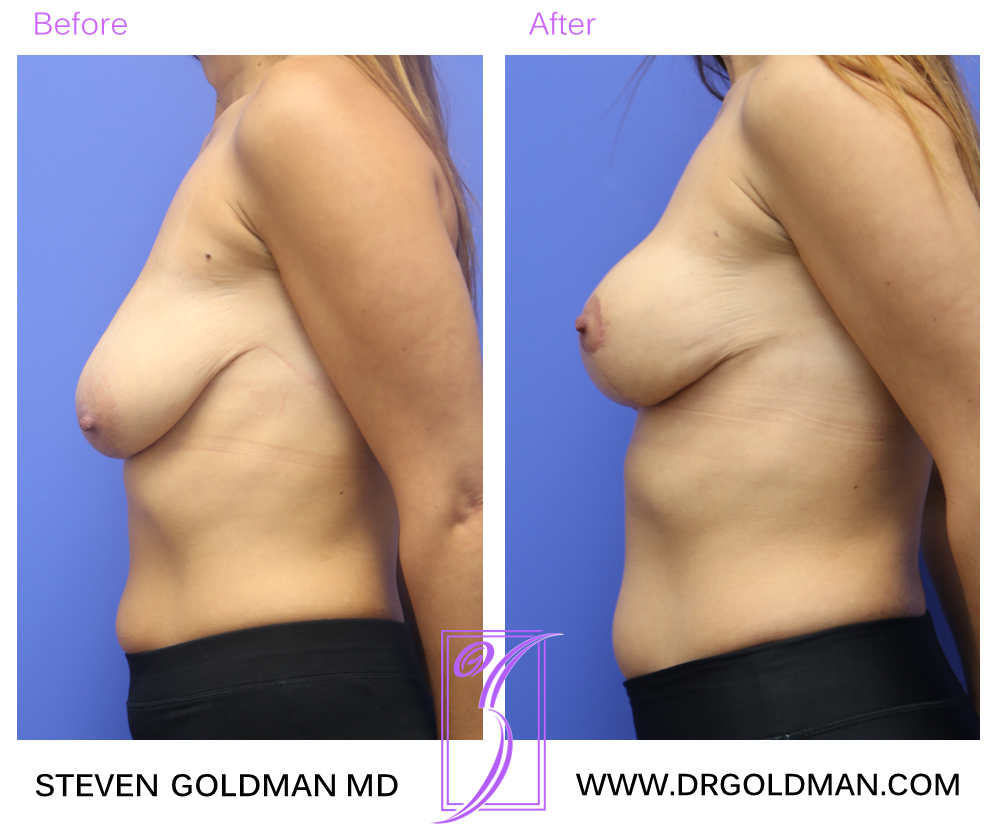 Breast Lift