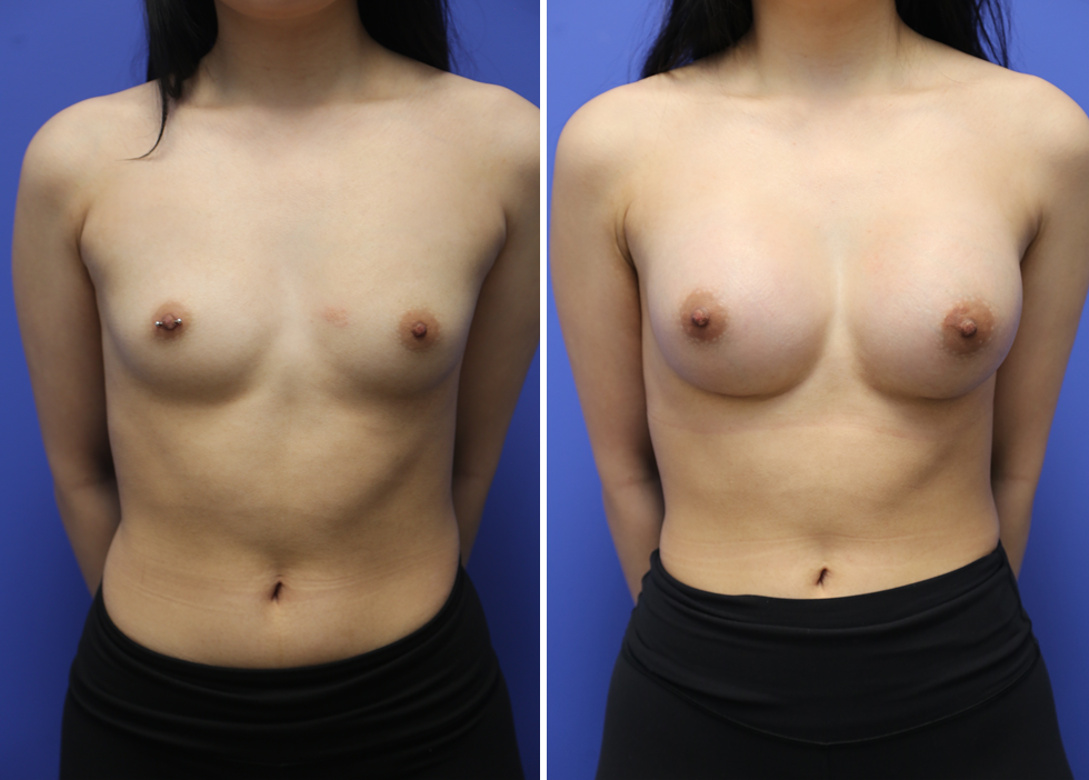 Breast Augmentation