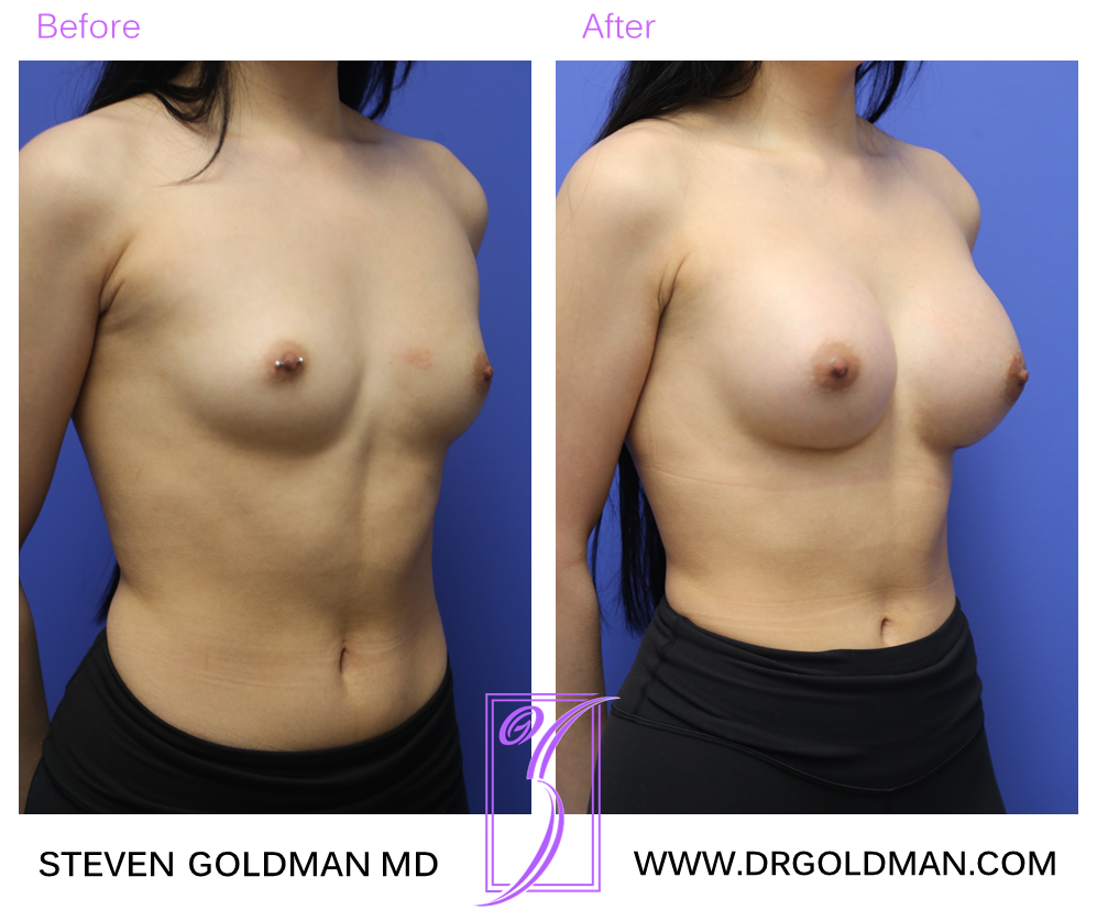 Breast Augmentation