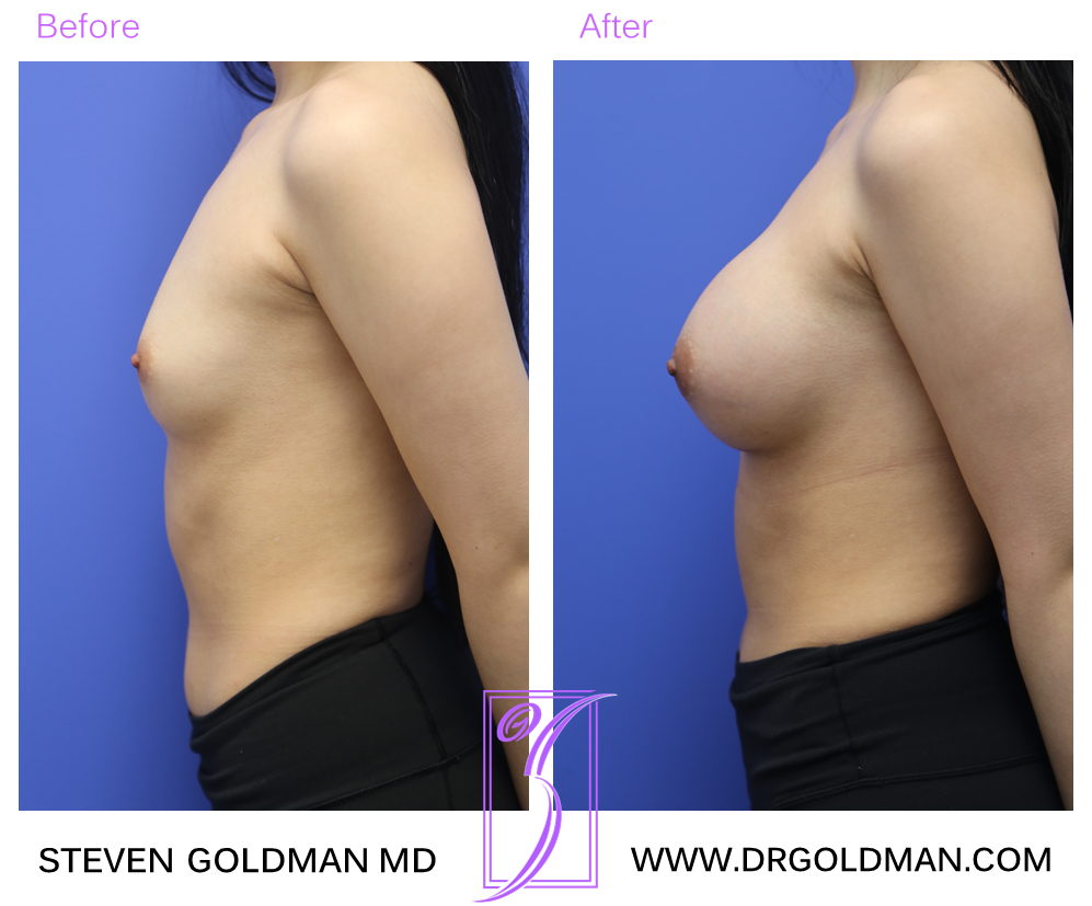 Breast Augmentation