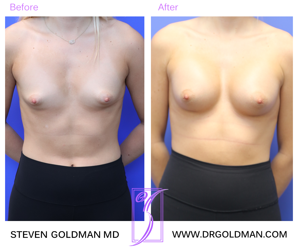 Breast Augmentation