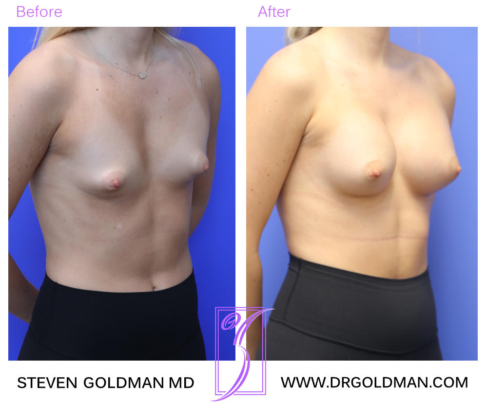 Breast Augmentation