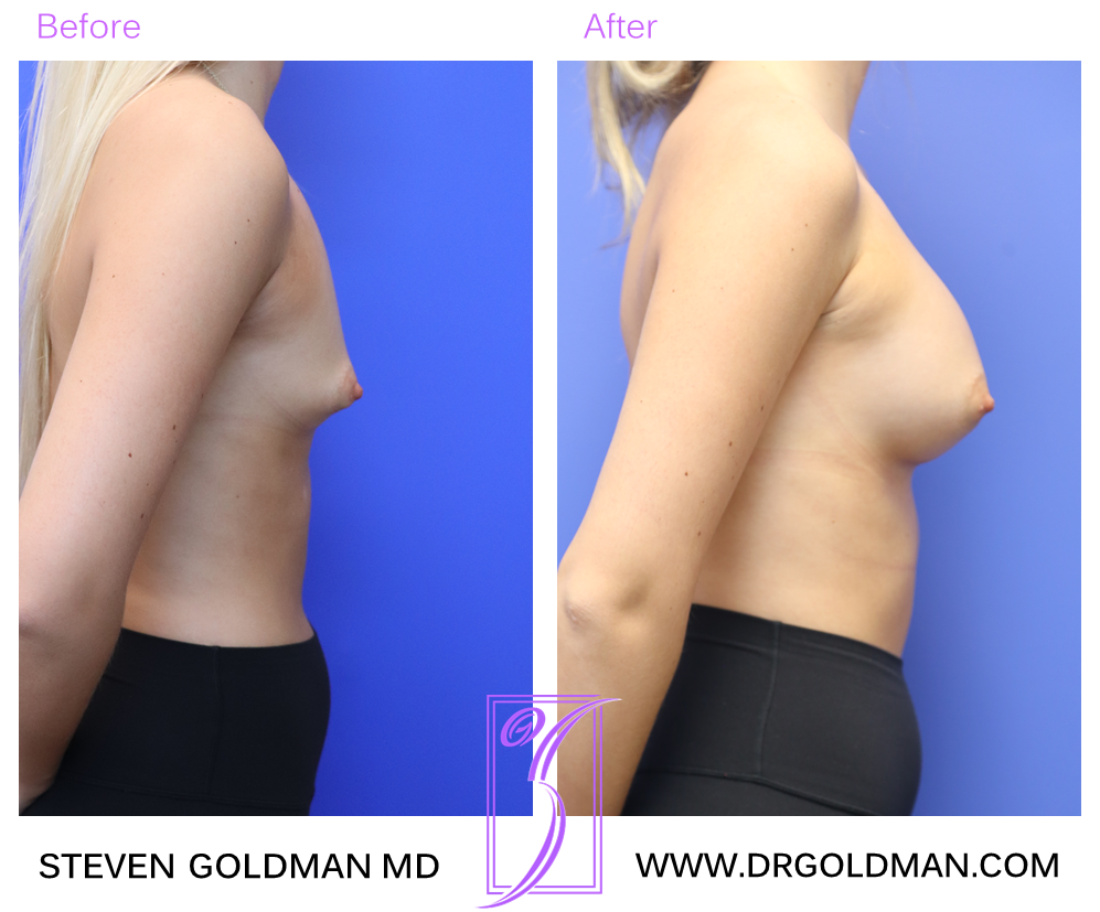 Breast Augmentation