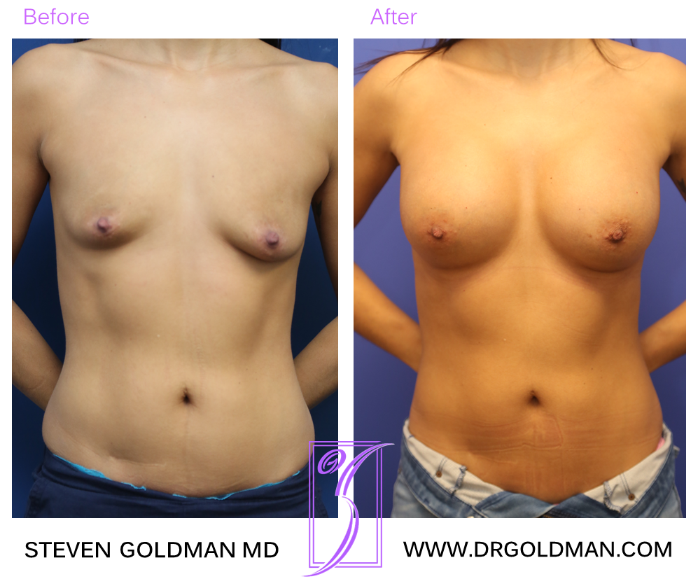 Breast Augmentation