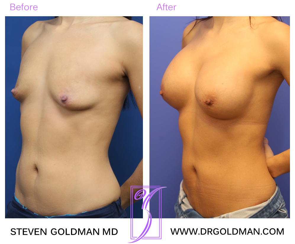 Breast Augmentation