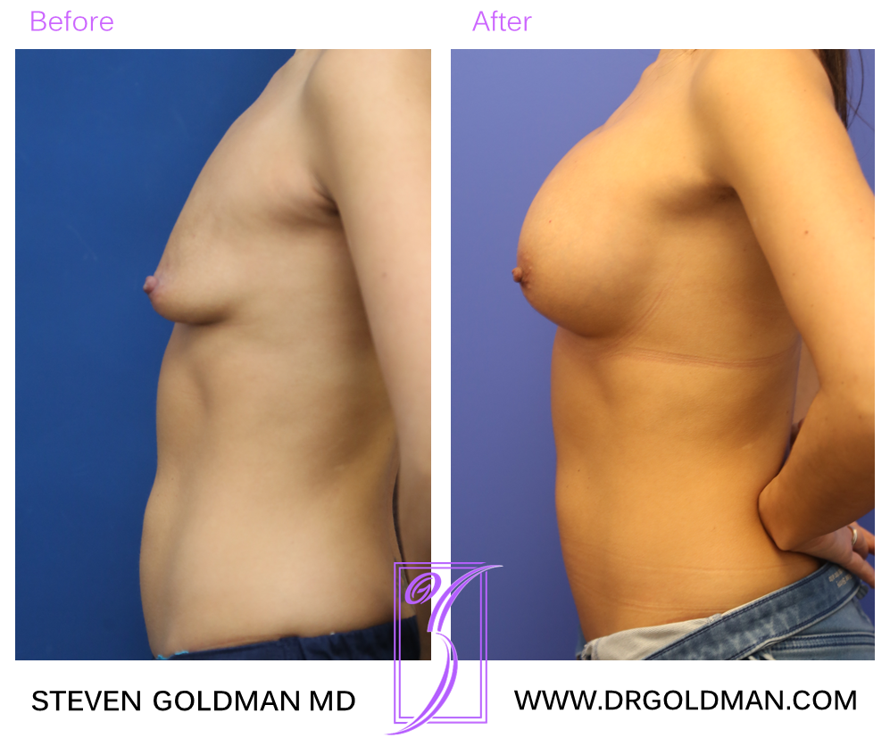 Breast Augmentation