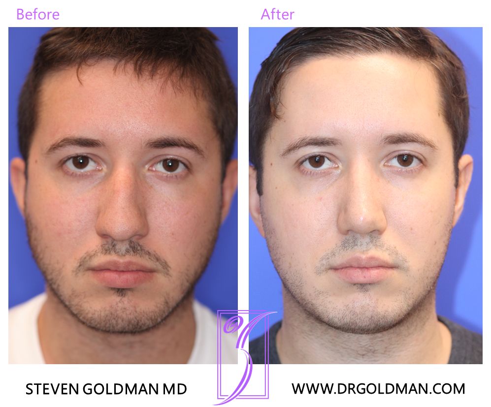 Rhinoplasty