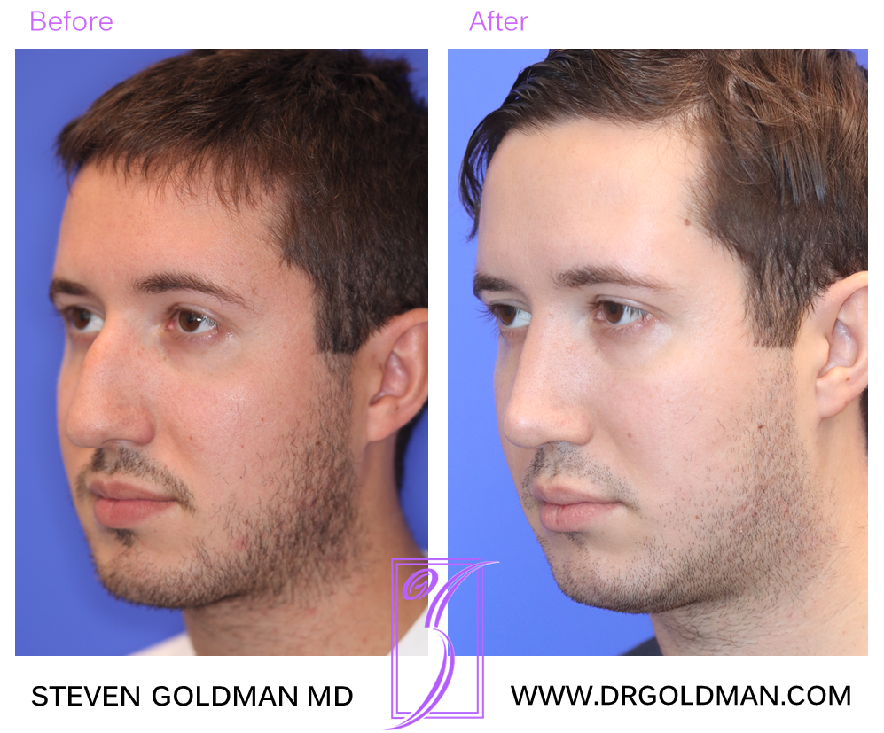 Rhinoplasty
