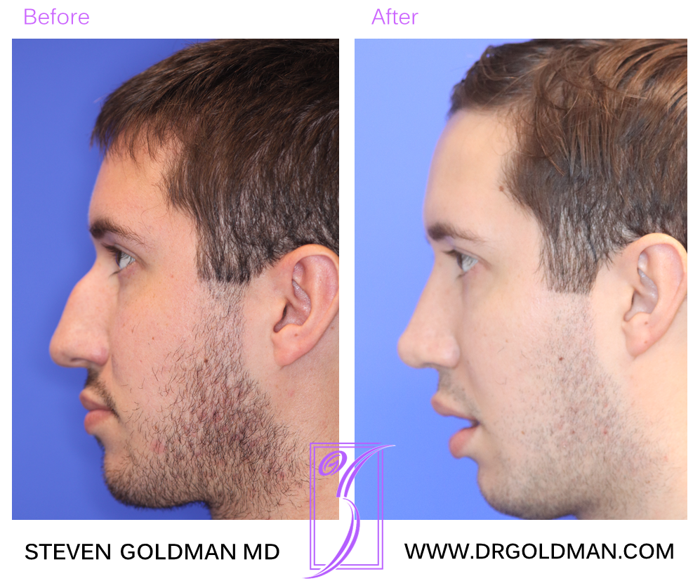 Rhinoplasty