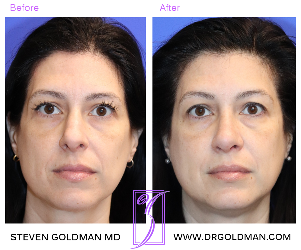 Rhinoplasty