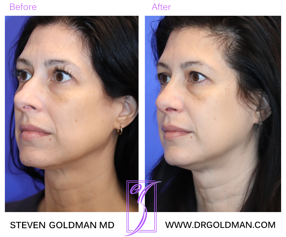 Rhinoplasty