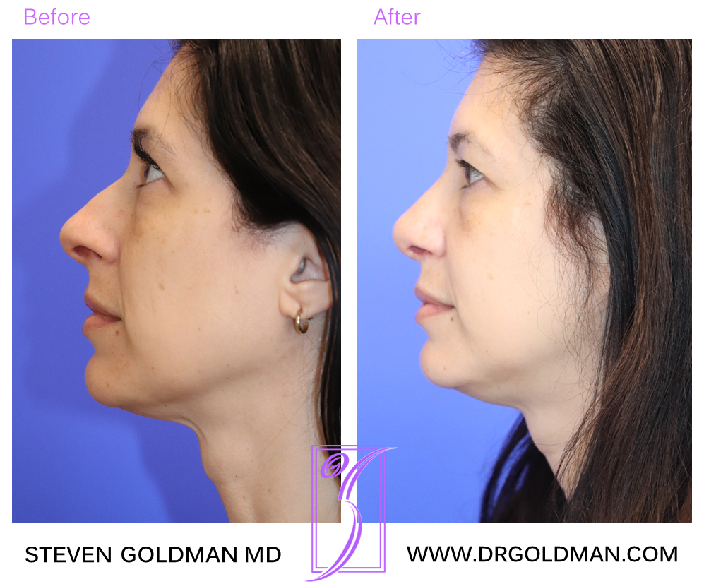 Rhinoplasty