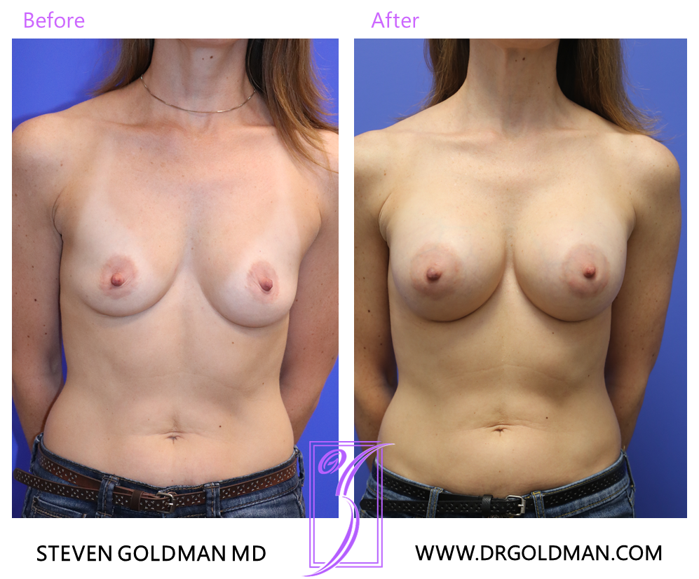Breast Augmentation