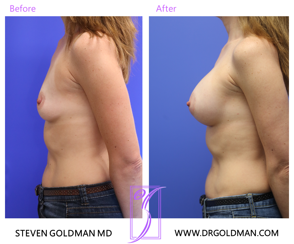 Breast Augmentation