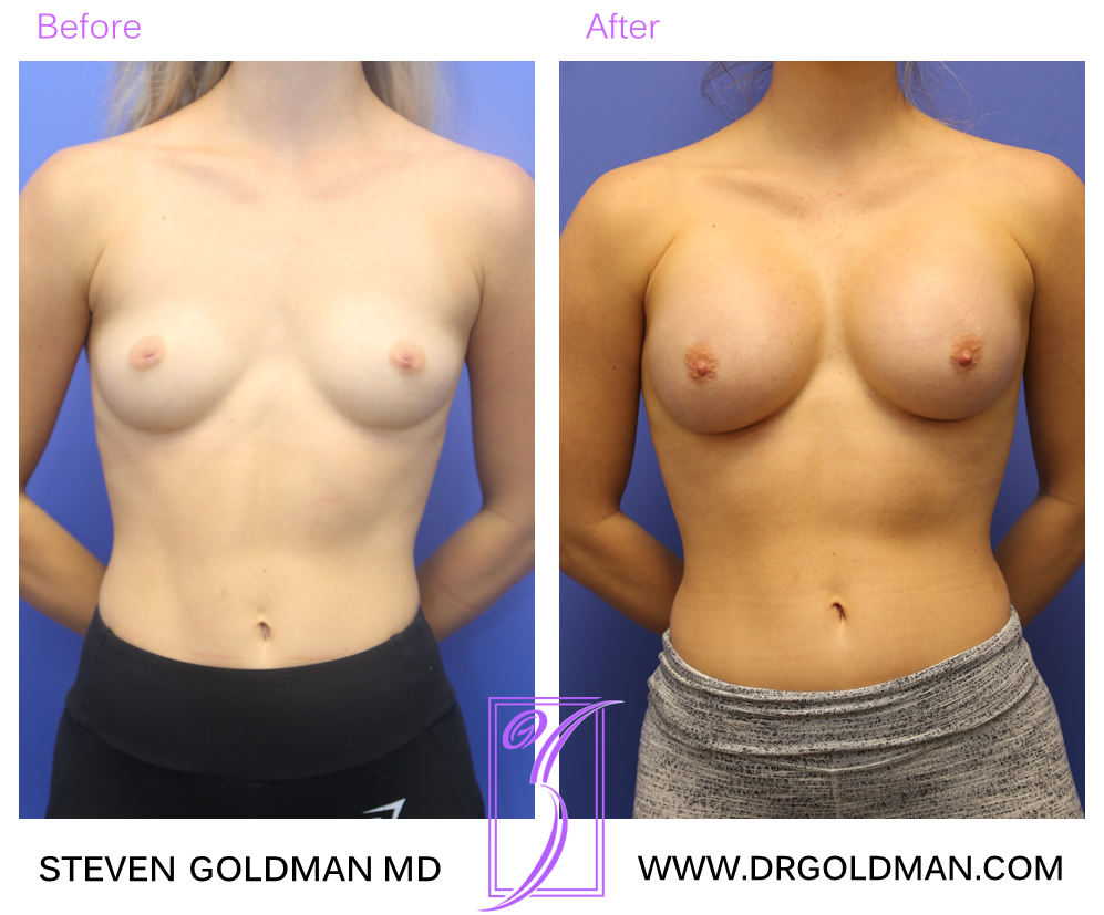Breast Augmentation
