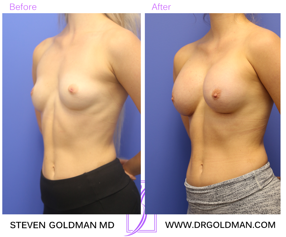 Breast Augmentation