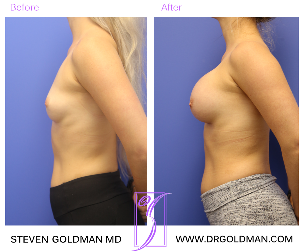 Breast Augmentation