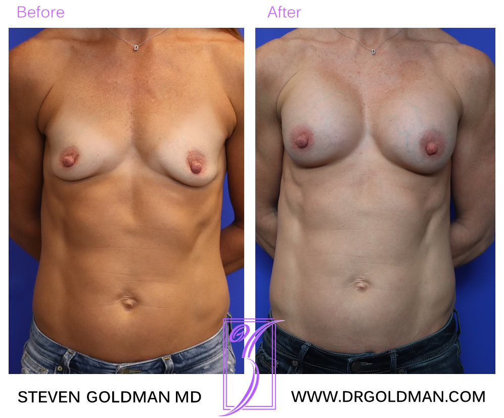 Breast Augmentation