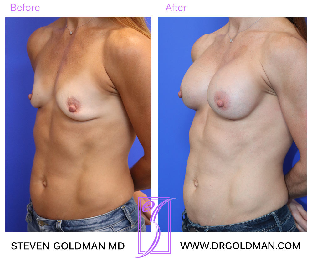 Breast Augmentation