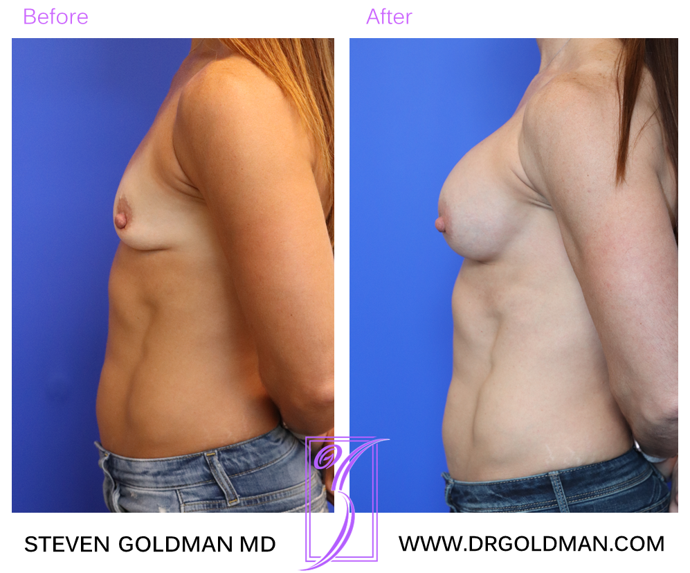 Breast Augmentation