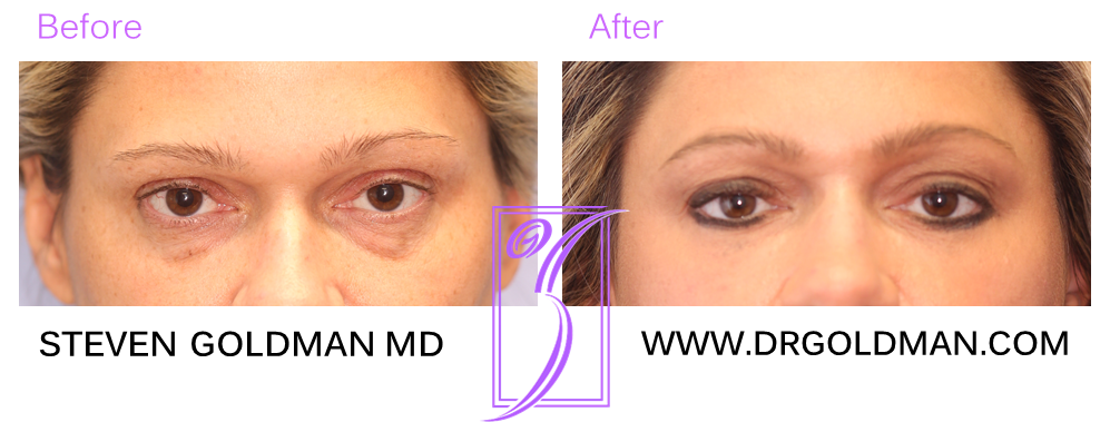 Blepharoplasty