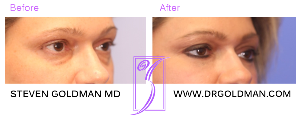 Blepharoplasty