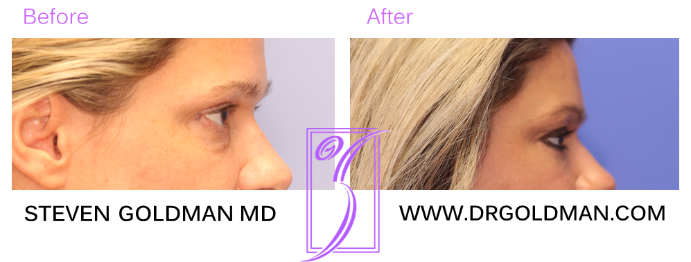 Blepharoplasty