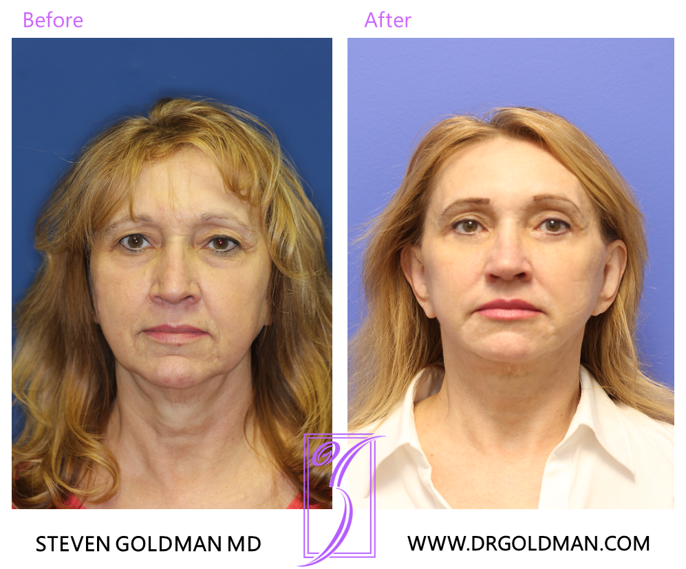 Facelift