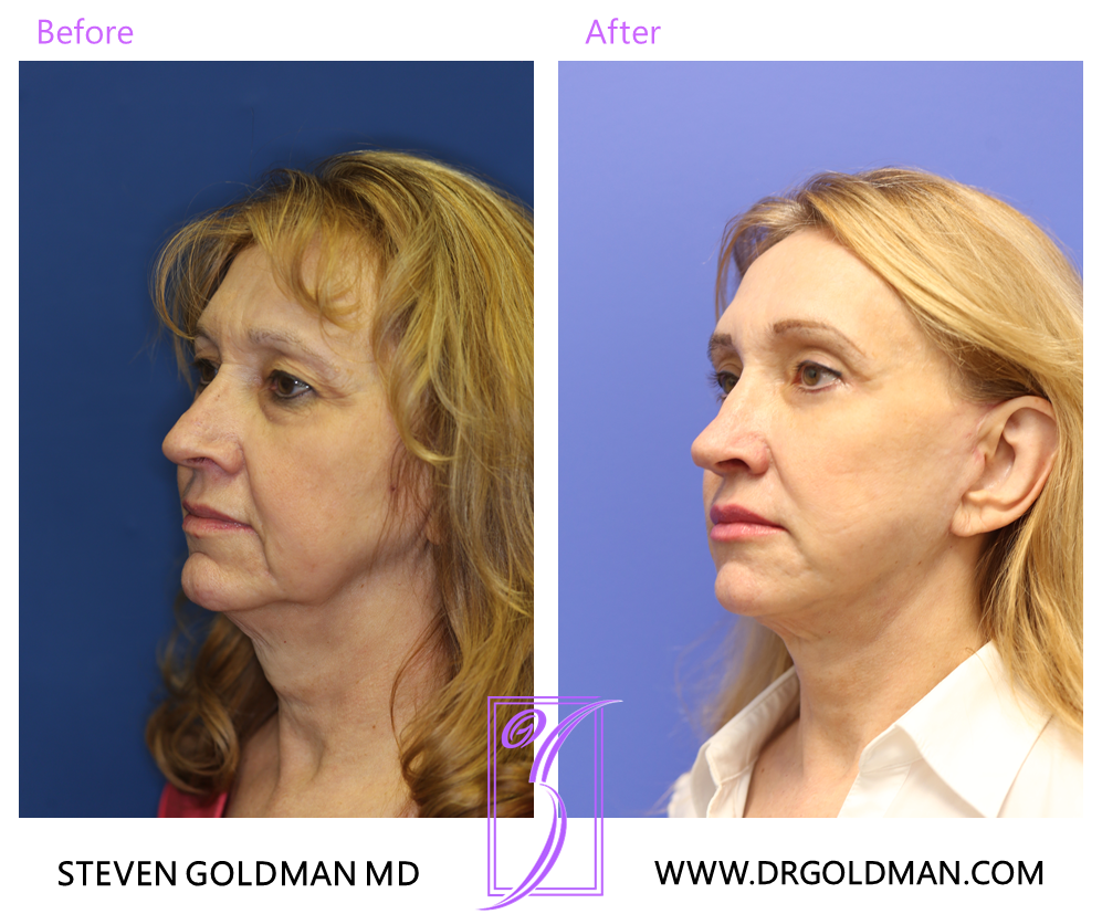 Facelift