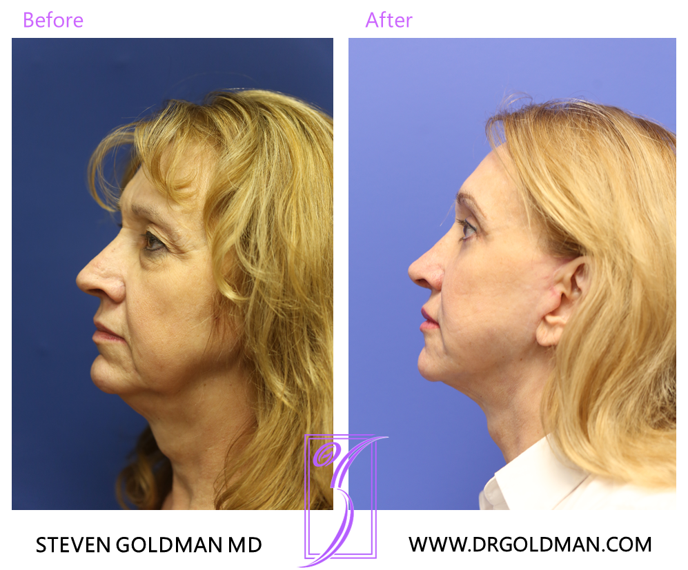 Facelift