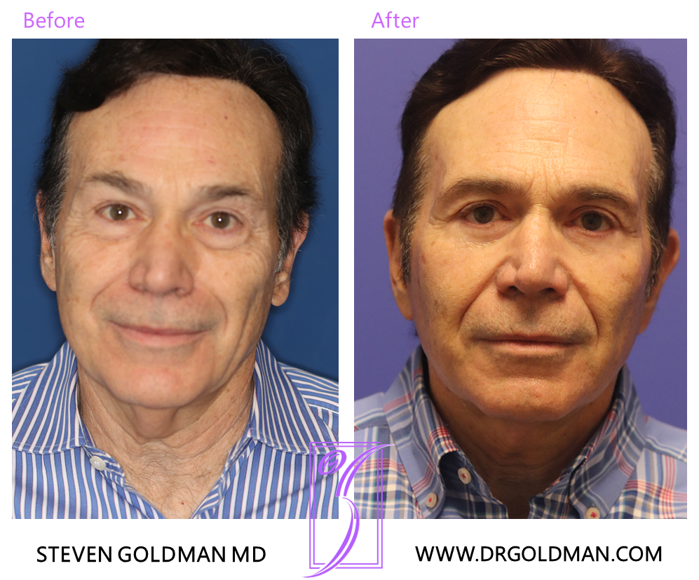 Facelift