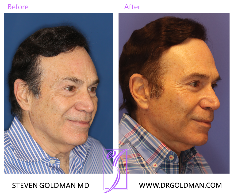 Facelift