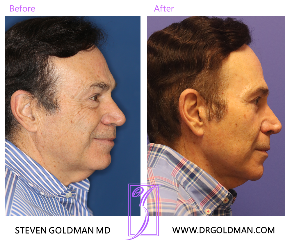 Facelift