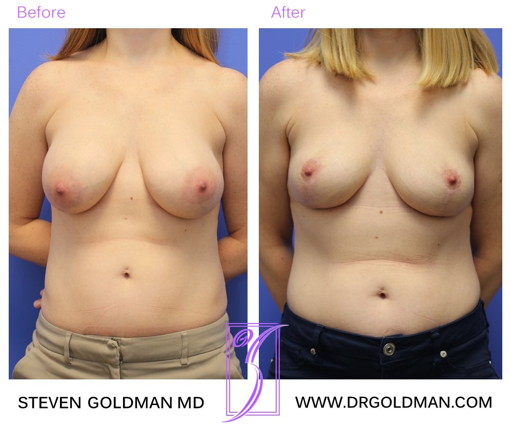 Breast Lift