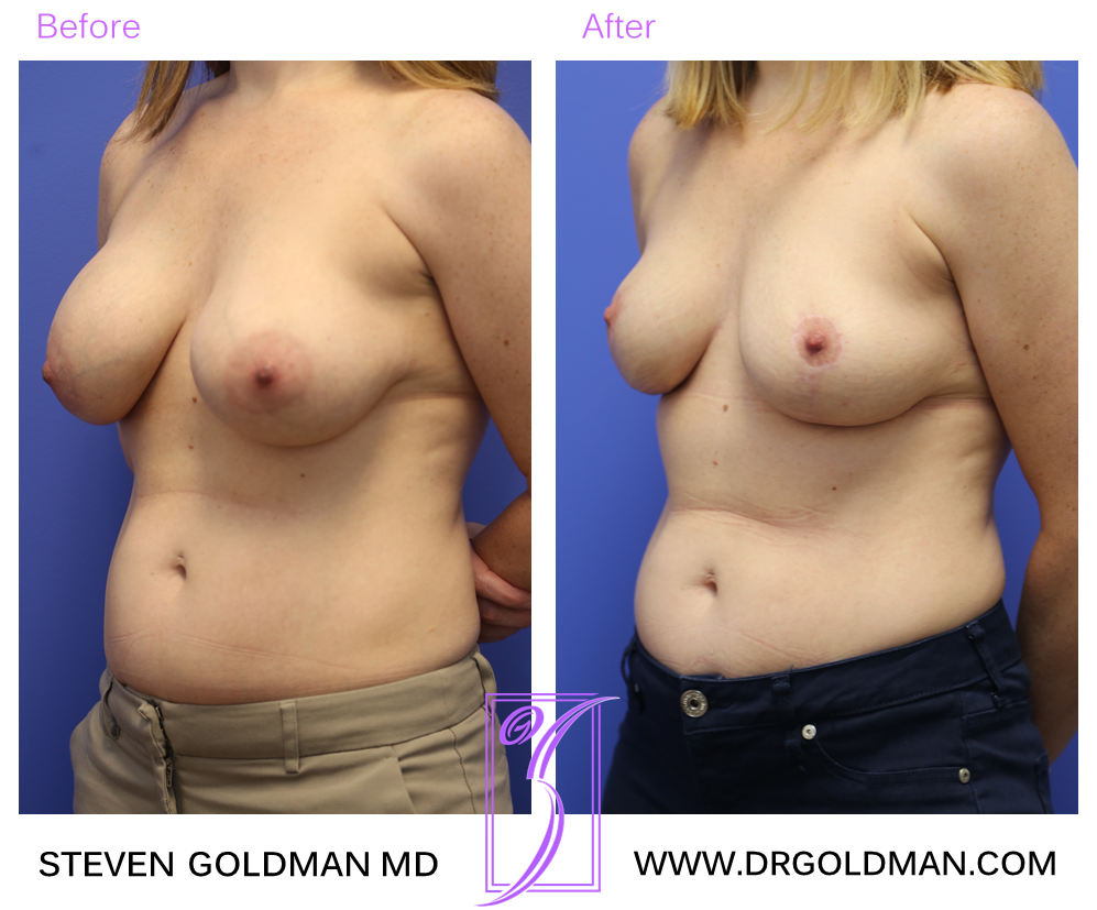 Breast Lift