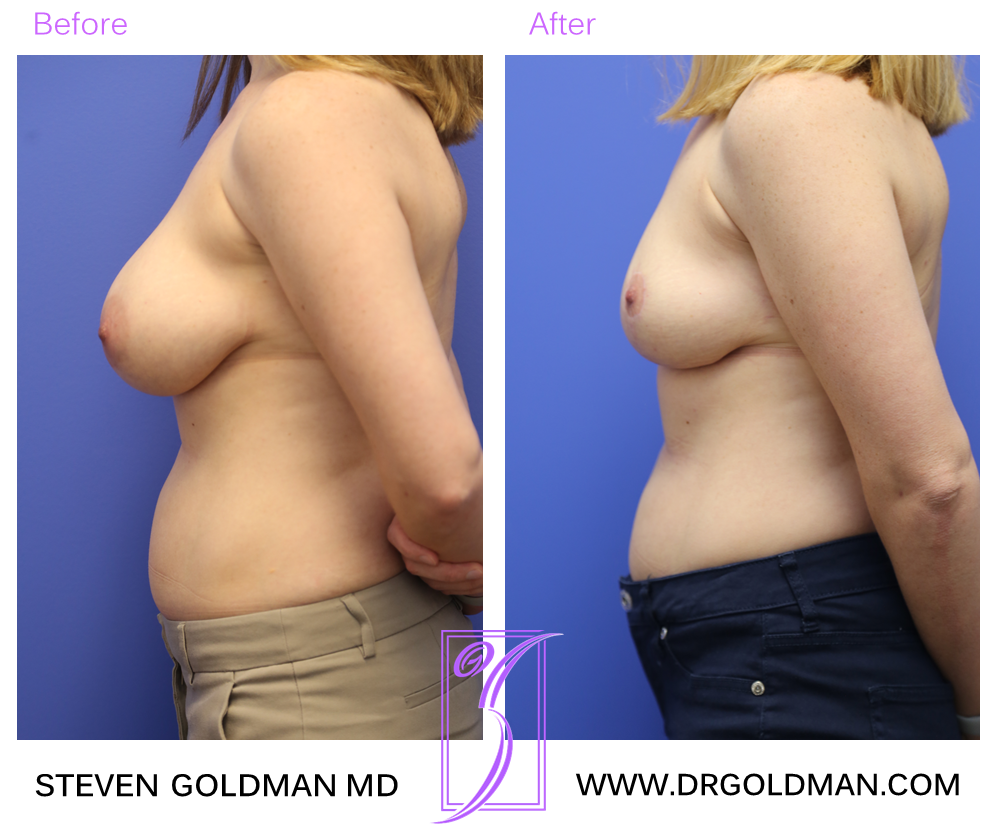Breast Lift