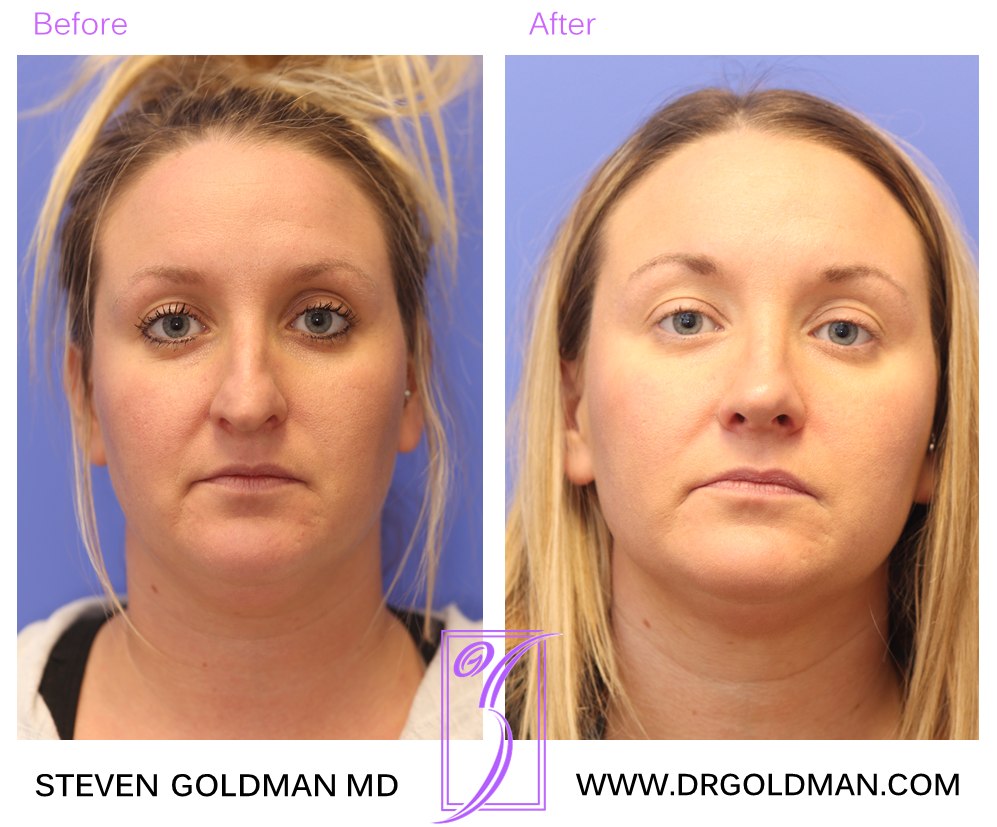 Rhinoplasty