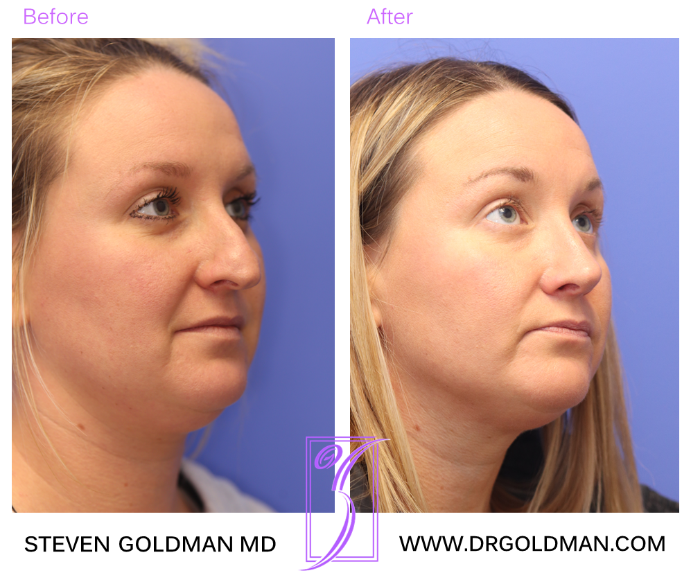 Rhinoplasty
