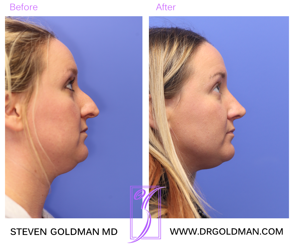 Rhinoplasty